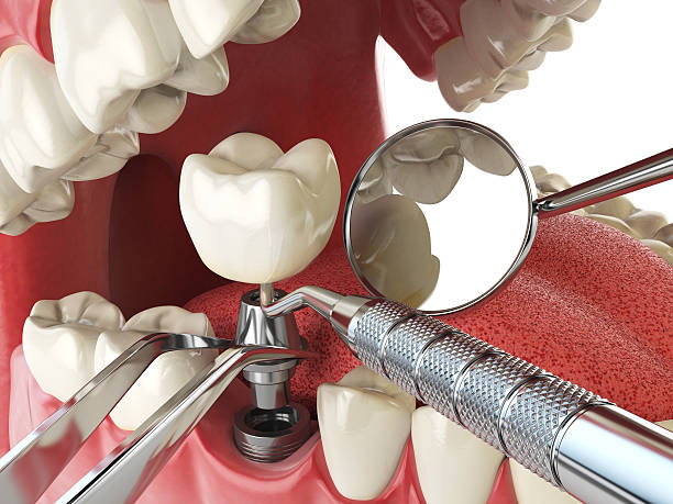 Best Emergency Gum Treatment in Monticello, IL